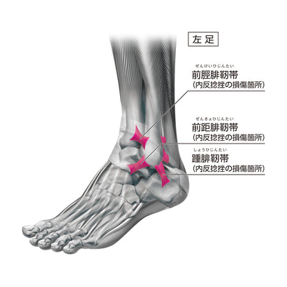 Adjustable Ankle Stabilizer